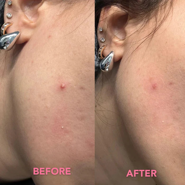 Patch Acne Anti-imperfezioni