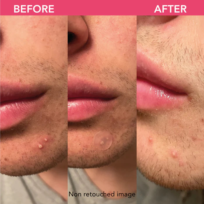 Patch Acne Anti-imperfezioni